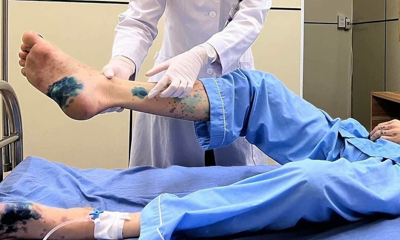 Phương pháp điều trị viêm mao mạch hoại tử