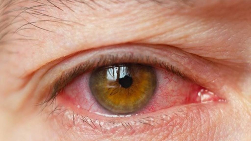 Viêm mắt dị ứng thời tiết: Nguyên nhân và cách phòng ngừa 1