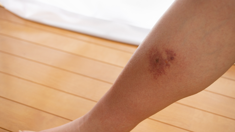 Viêm mô tế bào: Nguyên nhân, triệu chứng và điều trị 1