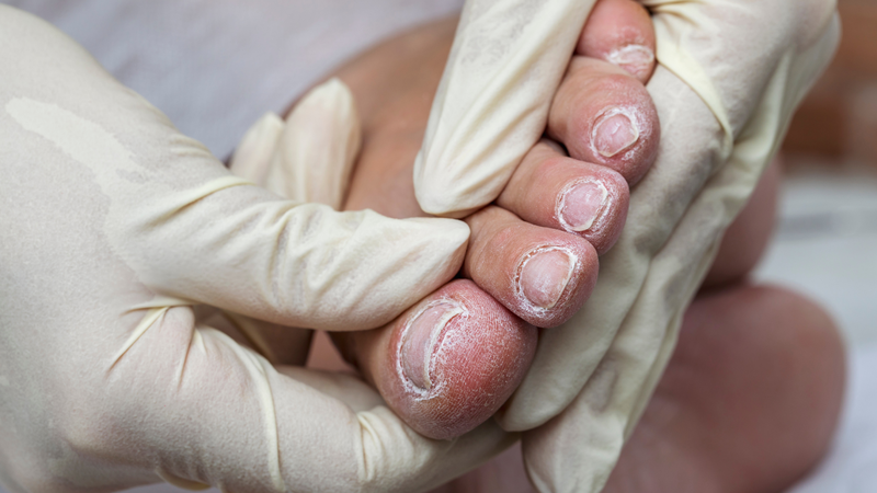 Viêm mô tế bào: Nguyên nhân, triệu chứng và điều trị 5