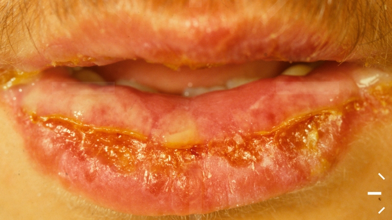 Viêm môi bong vảy sau phun môi 1