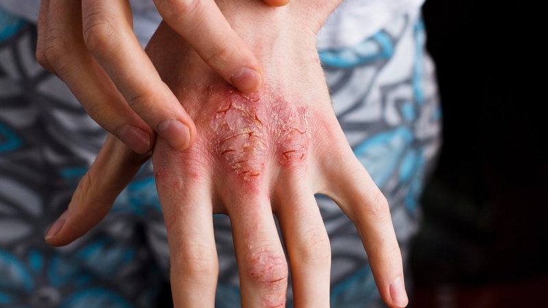 Viêm môi dị ứng là gì? Phương pháp điều trị viêm môi dị ứng 2