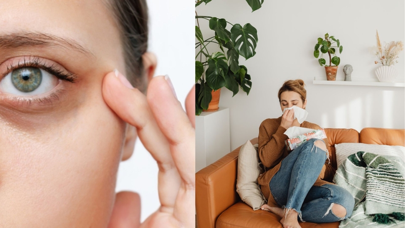 Mắt xuất hiện quầng thâm kèm ngứa mũi và hắt hơi là dấu hiệu cảnh báo viêm mũi dị ứng