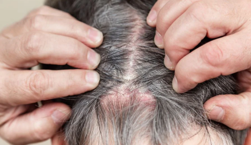 Viêm nang lông da đầu​ do đâu và cách điều trị? - 1