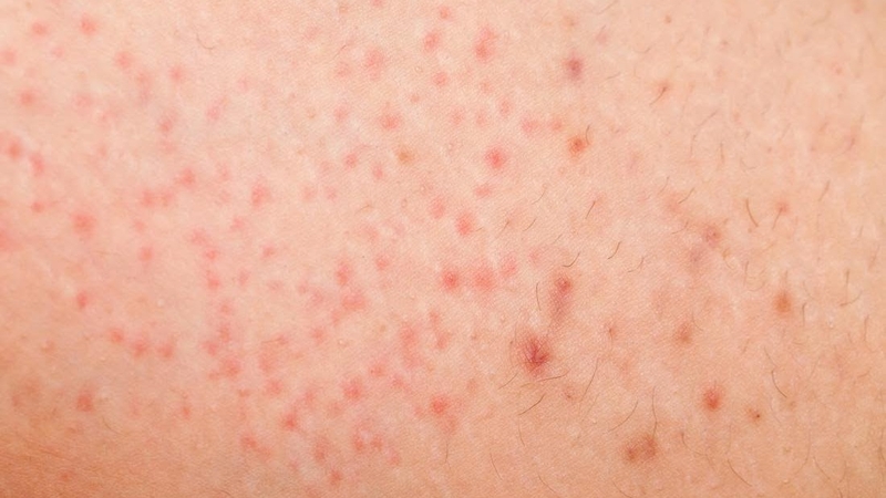 Viêm nang lông tuổi dậy thì và những điều cần biết 1