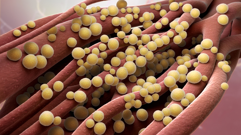 Tụ cầu khuẩn Staphylococcus aureus gây viêm nhiễm quanh nang lông