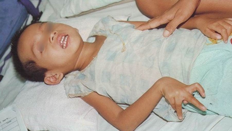 Viêm não cấp ở trẻ em: Nguyên nhân, triệu chứng, phương pháp điều trị 4