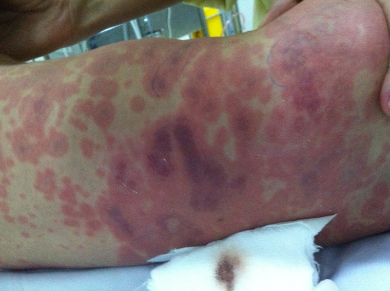 Viêm não mô cầu BC là bệnh gì? Có thể tiêm vắc xin phòng ngừa không? 1