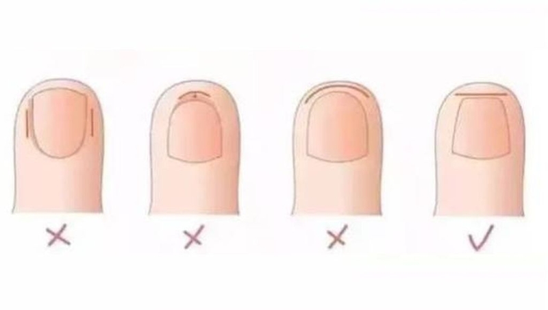 Viêm nếp gấp móng tay là gì? Cách chăm sóc móng tay khỏe mạnh 3