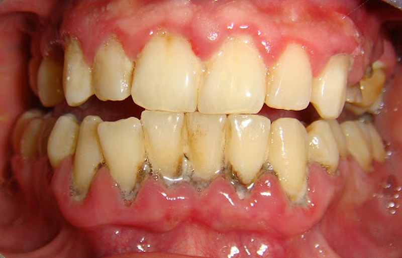 Những chia sẻ về vấn đề viêm nha chu có lây không mà bạn cần nên tham khảo