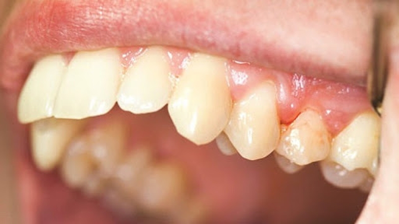 Những chia sẻ về vấn đề viêm nha chu có lây không mà bạn cần nên tham khảo