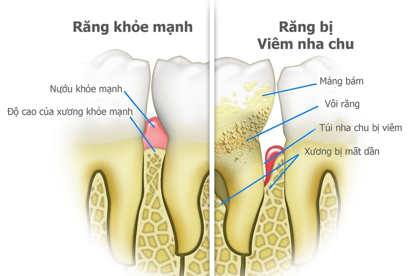 Viêm nha chu nặng có thể dẫn đến biến chứng nguy hiểm gì 1