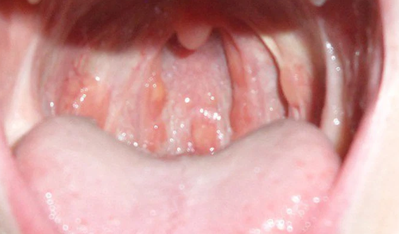 Viêm niêm mạc miệng hay loét miệng họng