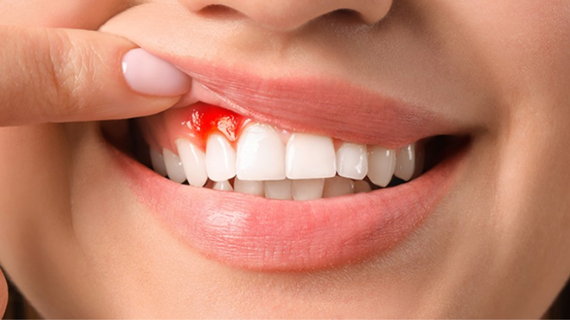 Viêm nướu răng có bị sốt không 1