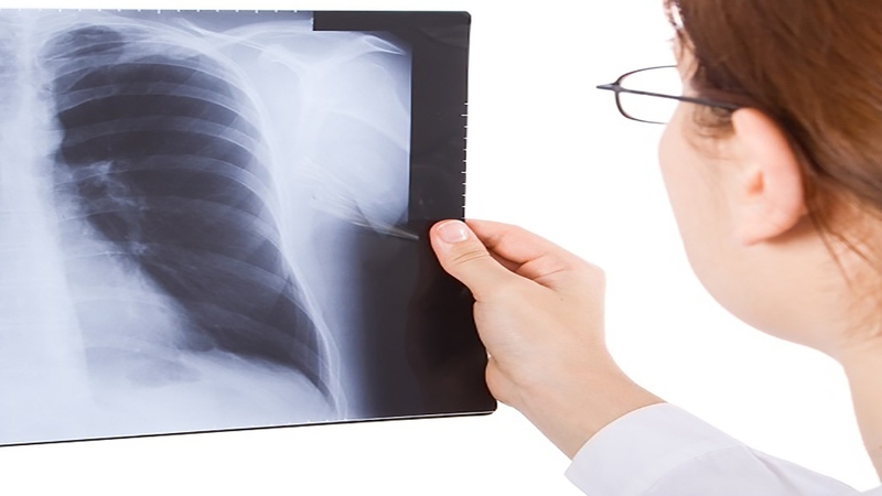 Viêm phế quản cấp j20 là gì? Triệu chứng bệnh ra sao? 3