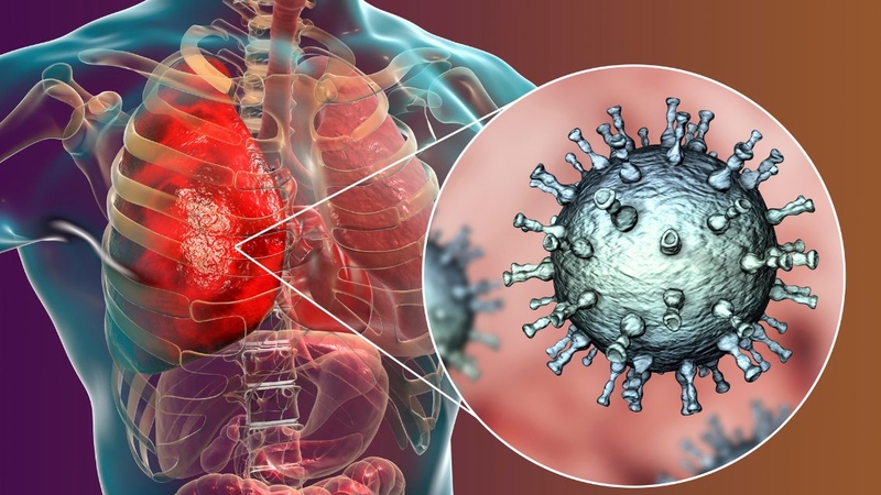 Viêm phổi cộng đồng và viêm phổi bệnh viện khác nhau như thế nào 1