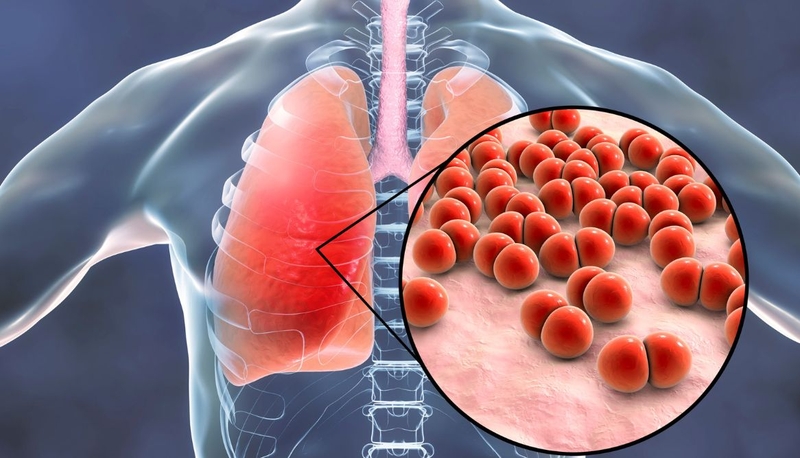 Viêm phổi do phế cầu có lây không? Cách phòng ngừa lây nhiễm 1
