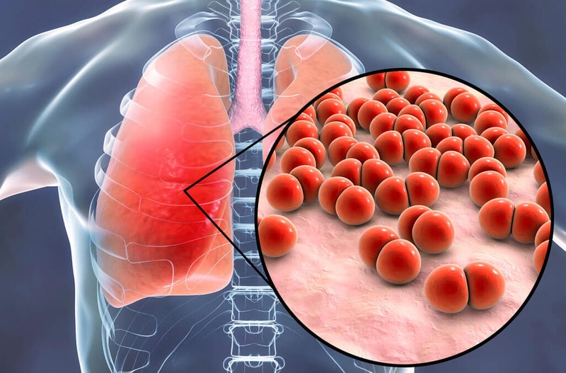 Viêm phổi là bệnh gì? Phân biệt viêm phổi do virus và vi khuẩn 1