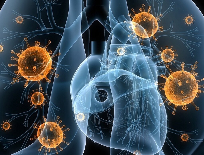 Viêm phổi là bệnh gì? Phân biệt viêm phổi do virus và vi khuẩn 2