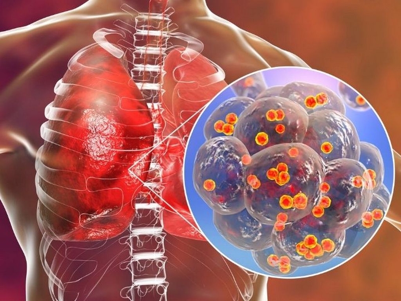 Viêm phổi PCP: Nguyên nhân, triệu chứng và cách điều trị hiệu quả 6