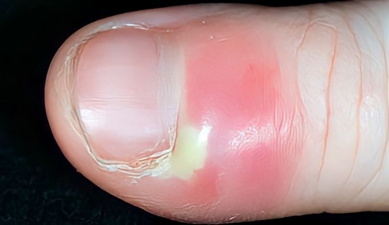 Viêm quanh móng là gì? Nguyên nhân gây bệnh và nguyên tắc phòng ngừa viêm quanh móng 4