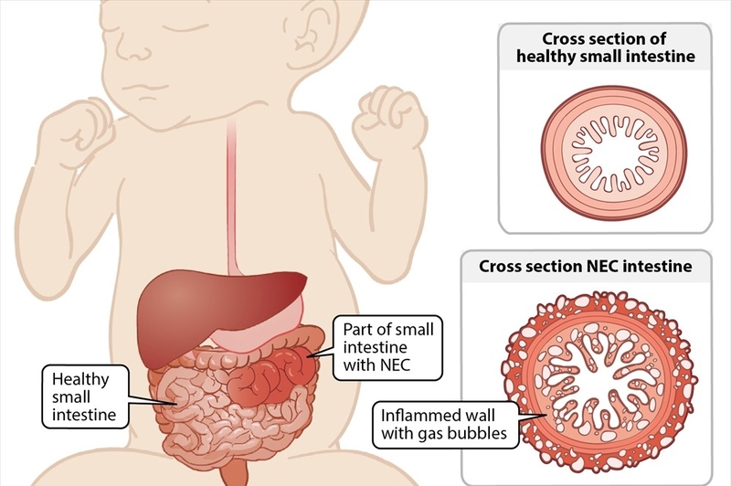 Viêm ruột hoại tử là gì? Nguyên nhân và cách điều trị 1