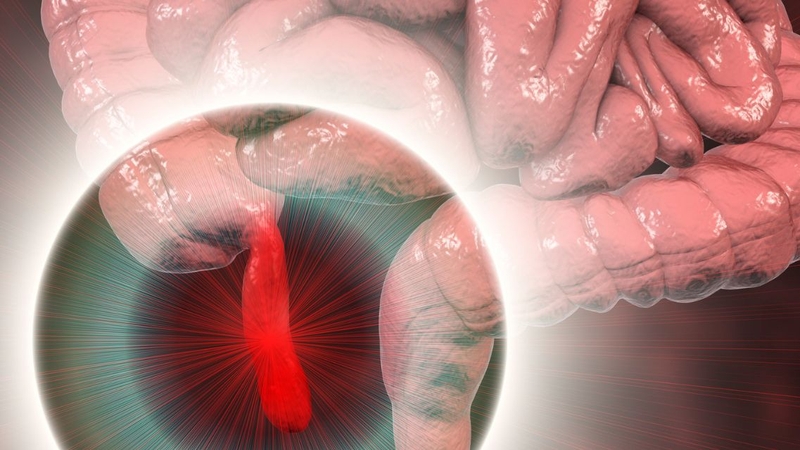 Viêm ruột thừa có tự khỏi&nbsp;không là thắc mắc của nhiều người