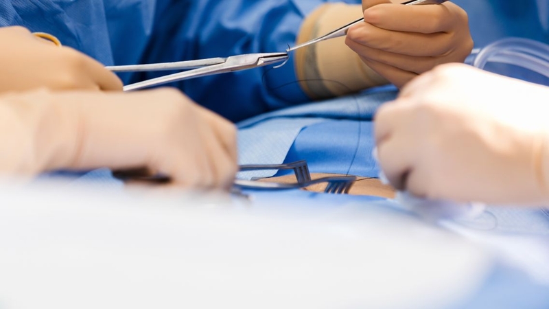 Phẫu thuật cắt ruột thừa là phương pháp điều trị dứt điểm viêm ruột thừa