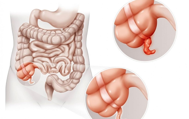 Viêm ruột thừa là gì? Cách chăm sóc bệnh nhân sau mổ ruột thừa tại nhà 1