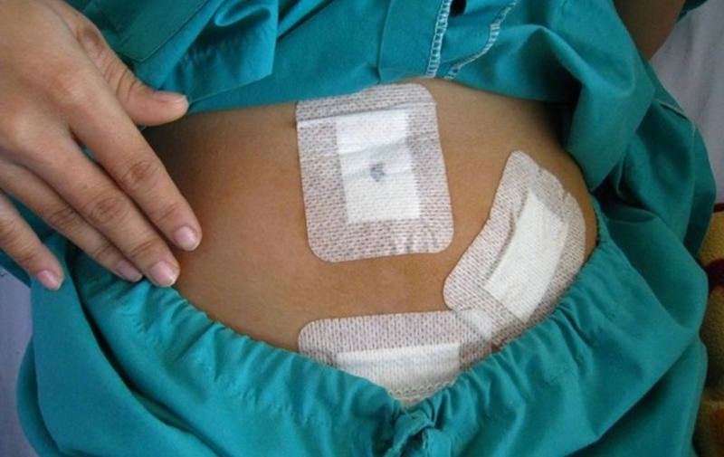 Viêm ruột thừa là gì? Cách chăm sóc bệnh nhân sau mổ ruột thừa tại nhà 3