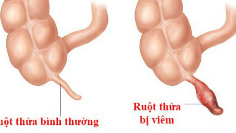Viêm ruột thừa là gì? Mổ ruột thừa bao lâu thì tắm được để không bị nhiễm trùng? 1