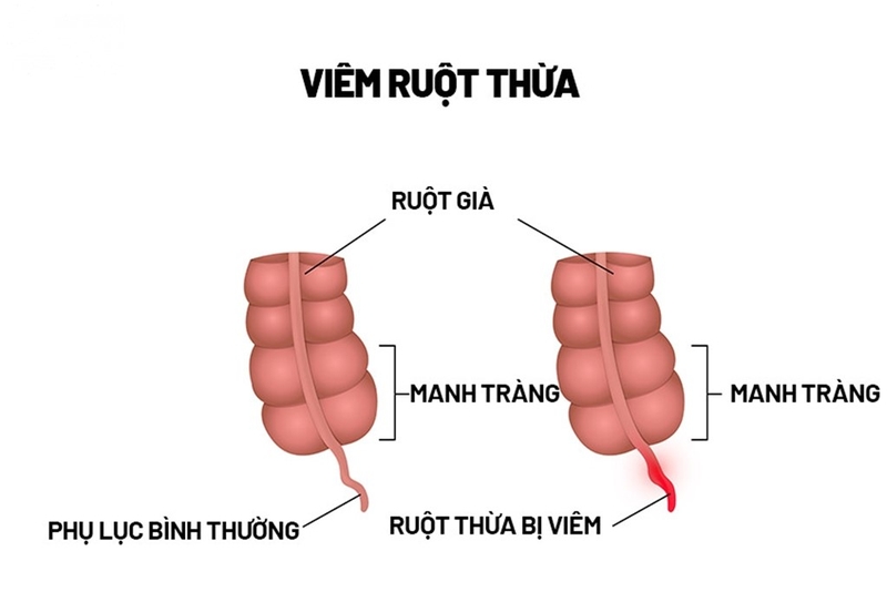 Nguyên nhân gây&nbsp;viêm ruột thừa ở trẻ em