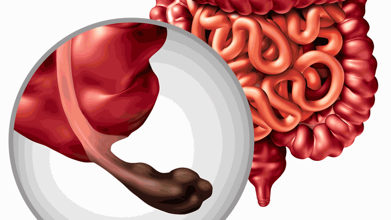 Phần ruột thừa bị viêm bên trong cơ thể