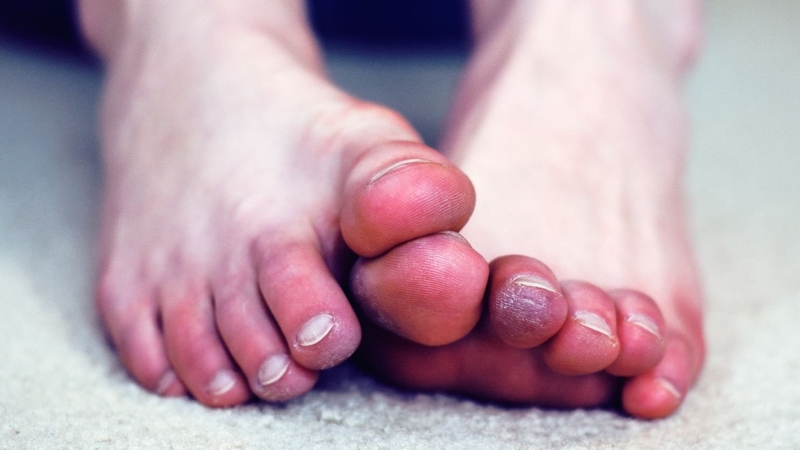 Viêm tắc động mạch là gì? Triệu chứng và phương pháp điều trị 2