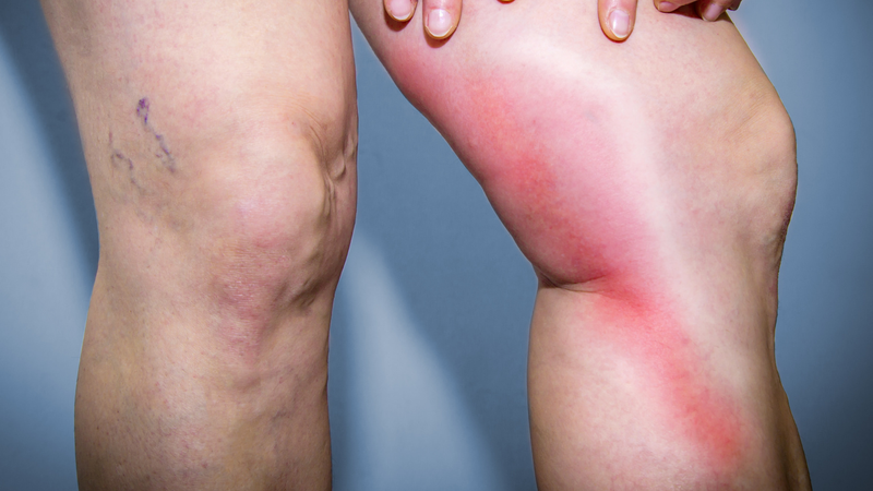 Viêm tắc tĩnh mạch: Nguyên nhân, triệu chứng và điều trị 1