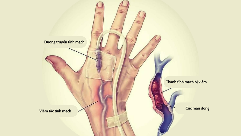 Viêm tắc tĩnh mạch: Nguyên nhân, triệu chứng và điều trị 2