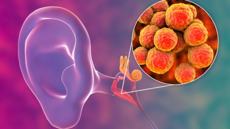 Viêm tai giữa do phế cầu khuẩn: Nguyên nhân, triệu chứng, chẩn đoán và điều trị 1