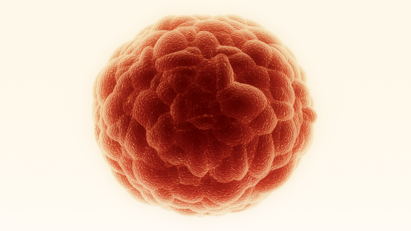 Viêm tai giữa mạn tính có cholesteatoma là gì bạn đã biết rõ hay chưa?2