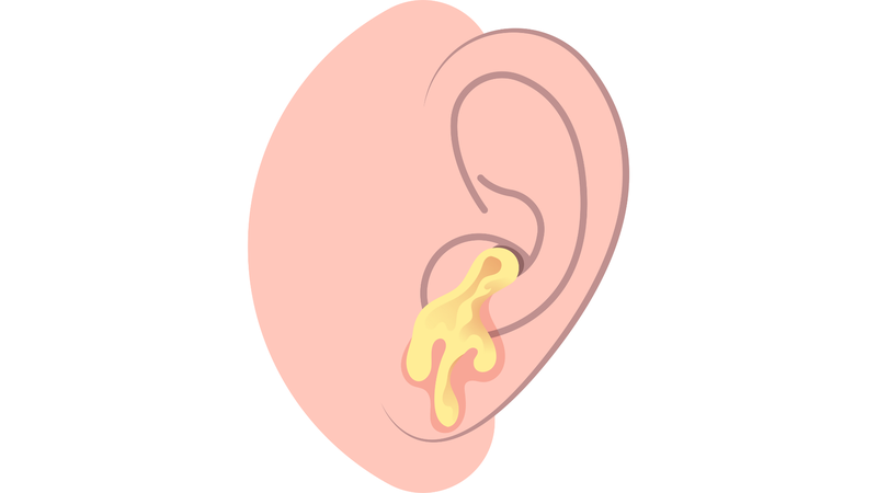 Viêm tai giữa mạn tính mủ và những triệu chứng điển hình là gì?1