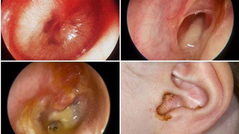 Viêm tai giữa mạn tính thủng nhĩ có nguy hiểm không?