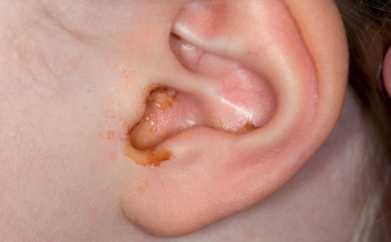 Thắc mắc: Viêm tai giữa ứ dịch bao lâu thì khỏi? 1
