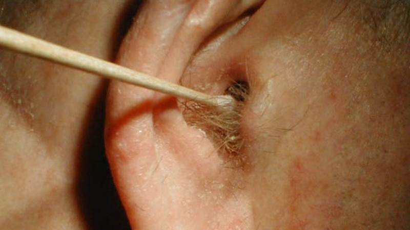 Viêm tai ngoài có mủ có nguy hiểm không? Cách điều trị hiệu quả 1