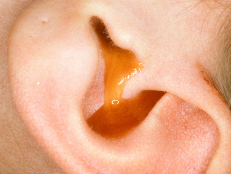 Viêm tai ngoài là gì? Nguyên nhân và cách điều trị 3