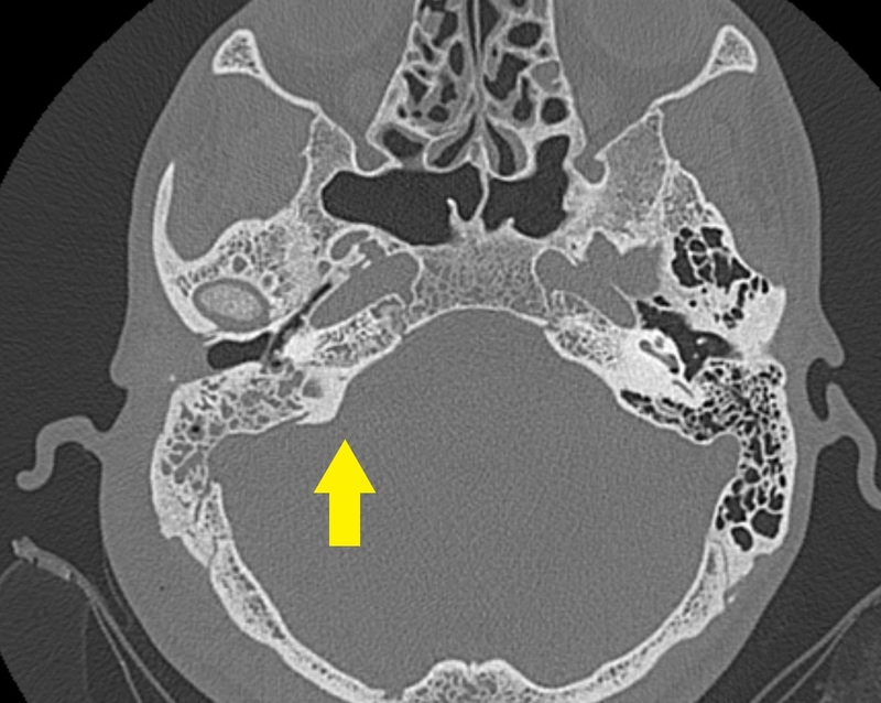 Viêm tai xương chũm mạn tính: Triệu chứng, cách điều trị1