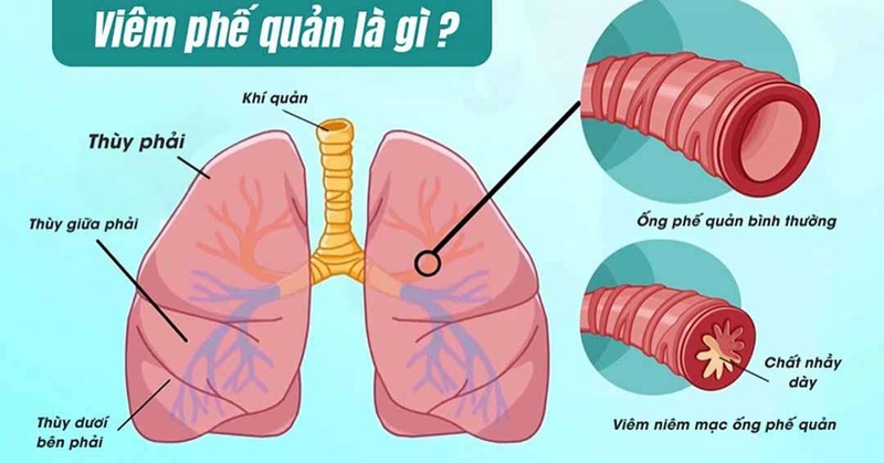 Viêm tiểu phế quản khác viêm phế quản thế nào ở trẻ em 1