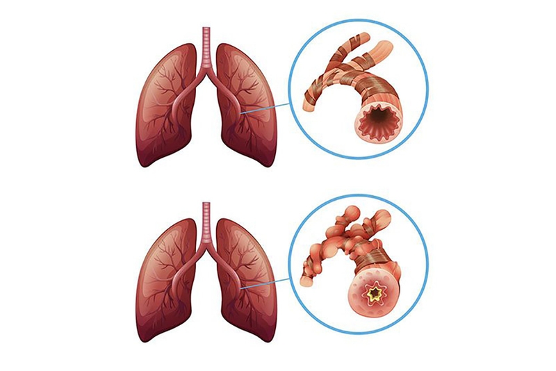Viêm tiểu phế quản tắc nghẽn: Nguyên nhân, triệu chứng và cách điều trị 3