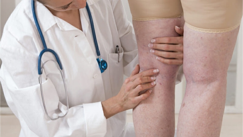Viêm tĩnh mạch: Nguyên nhân, triệu chứng và cách điều trị bệnh 3