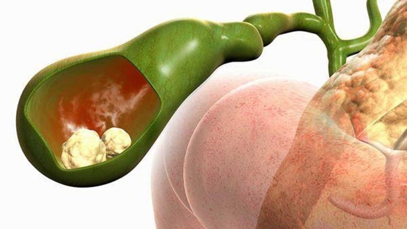 viêm túi mật hoại tử và những điều cần biết