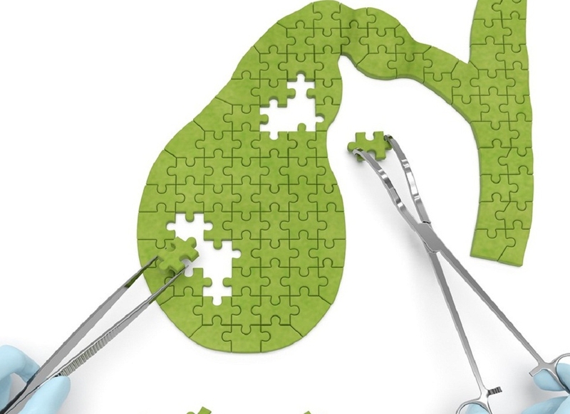 Viêm túi mật không do sỏi: Triệu chứng, chẩn đoán và điều trị 1