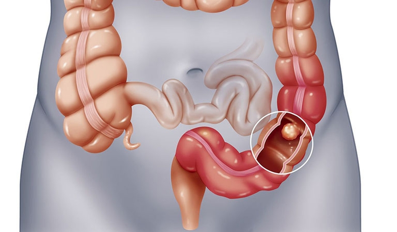 Viêm túi thừa đại tràng là gì? Có nguy hiểm không? 1